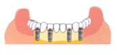 インプラントを土台にして入れ歯を安定させ、動かさず、しっかりした義歯にする、または自然な状態で再建